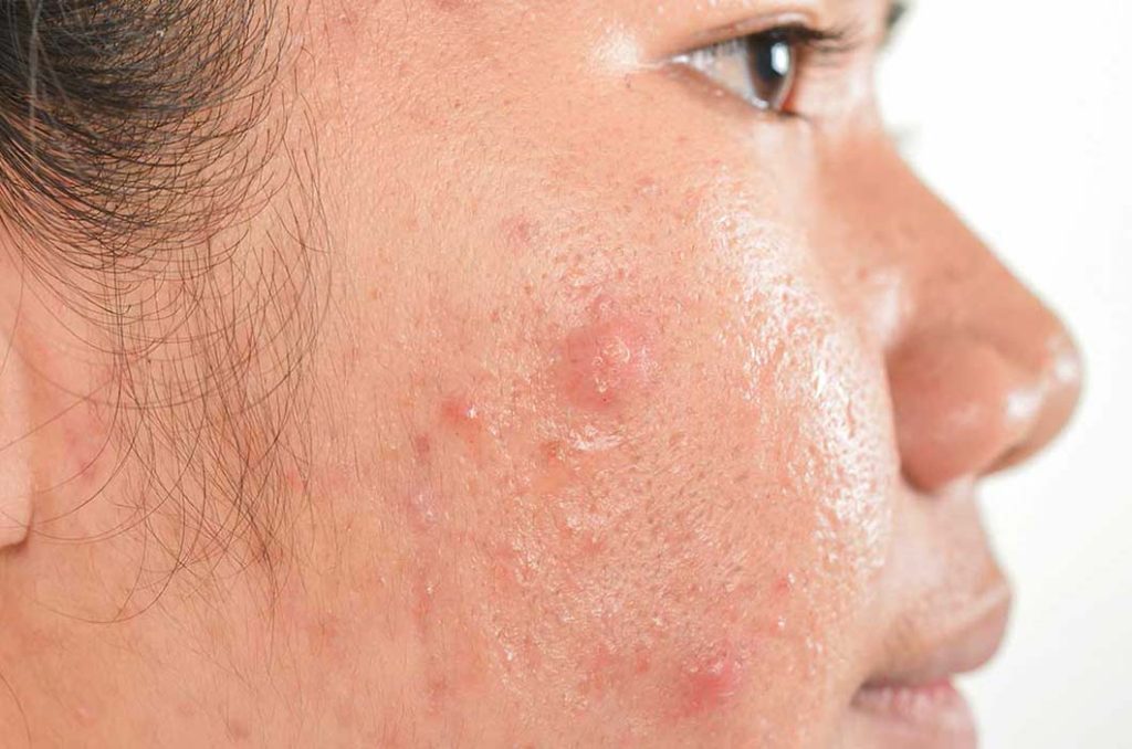 Diminishing Acne Scars: Recommended Acne Scar Removal Products and Techniques